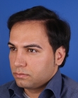 After Hair Transplant&nbsp;Front